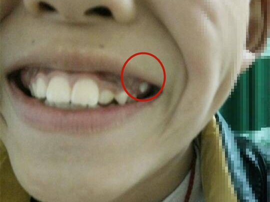 家住綦江的一位家长爆料称,自家孩子的牙齿非常奇怪,好好的牙龈上面