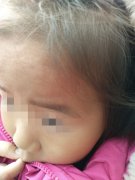 两小孩耍得太嗨 眼睛额头碰一起了