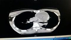 荣昌男子胸腔长8厘米胎瘤“吞噬”血管