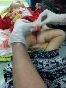 一岁零4个月大的男童被自家小狗咬掉“小鸡鸡”