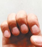 重庆小伙爱咬指甲 20多年来从没用过指甲剪刀