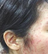 女白领天天敷面膜 痘痘不减反增