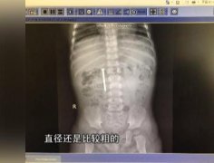 惊险！1岁男孩吞水泥钉子