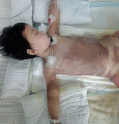 重庆一3岁女童一屁股坐进开水桶  被烫休克