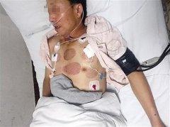 男子轻信小店针灸能治肩颈痛 被刺破双肺