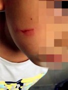 男孩抢玩具一口把小朋友脸咬出了血 妈妈求助：该怎么办？
