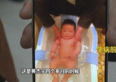 重庆男童腹泻8个月 骨瘦如柴生命垂危
