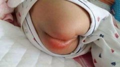 两个月大的宝宝出现红屁股 红得就像是快破掉了一样
