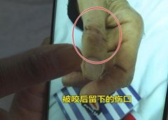 女子住院被老鼠咬伤流血 如今和医院协商赔偿事宜